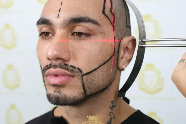 Vergleich von DHI und FUE bei der Barttransplantation