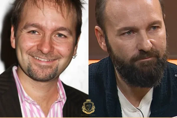 Daniel Negreanu Haartransplantation