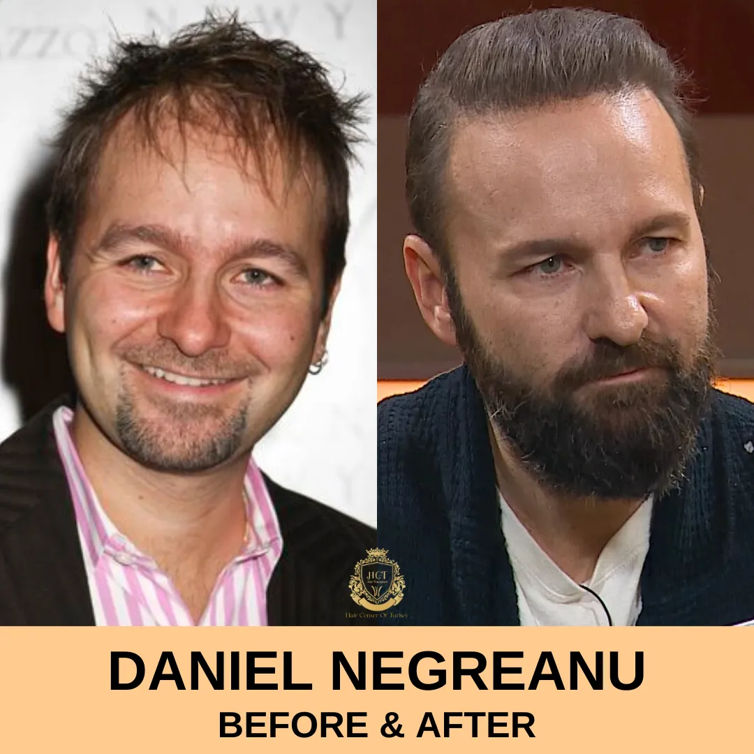 Daniel Negreanu Trasplante de pelo 1 Daniel Negreanu Hair Transplant