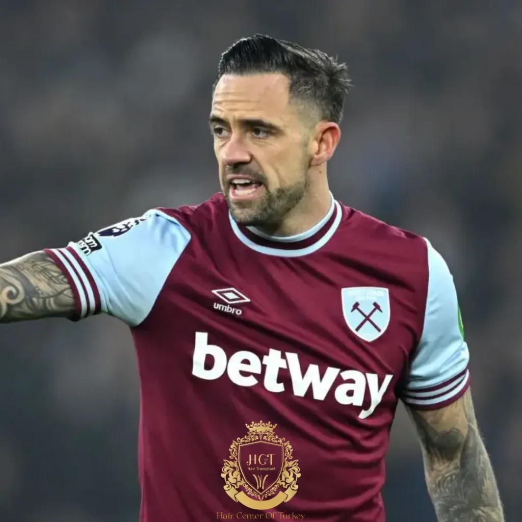 Danny Ings ha fatto un trapianto di capelli