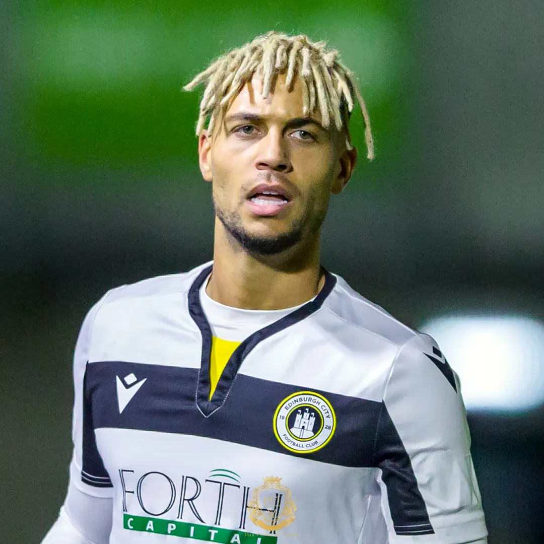 Did Ouzy See Get a Hair Transplant F