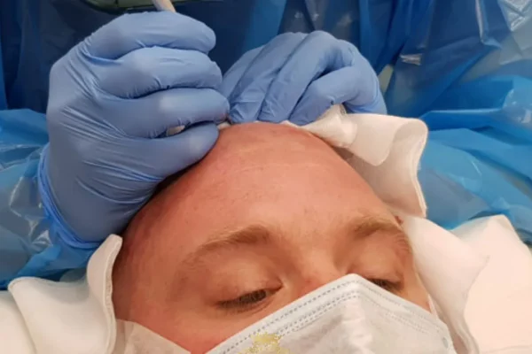Hat Peter „Tubes“ Dale eine Haartransplantation gehabt?