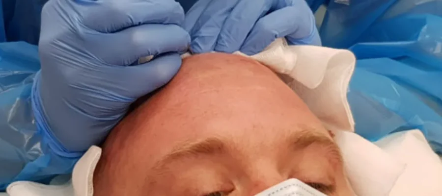 Did Peter “Tubes” Dale Have a Hair Transplant F