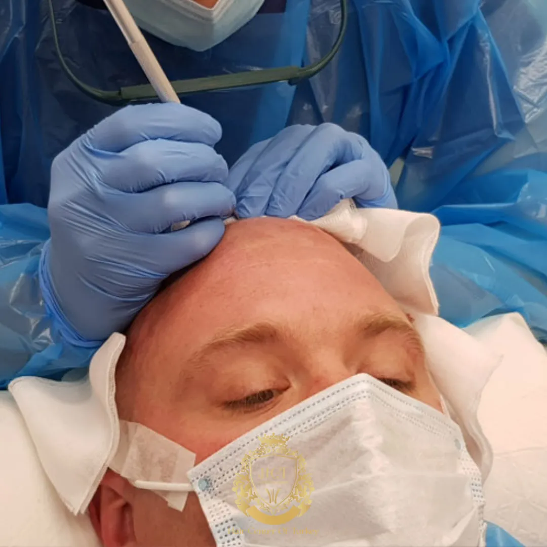 Did Peter “Tubes” Dale Have a Hair Transplant F