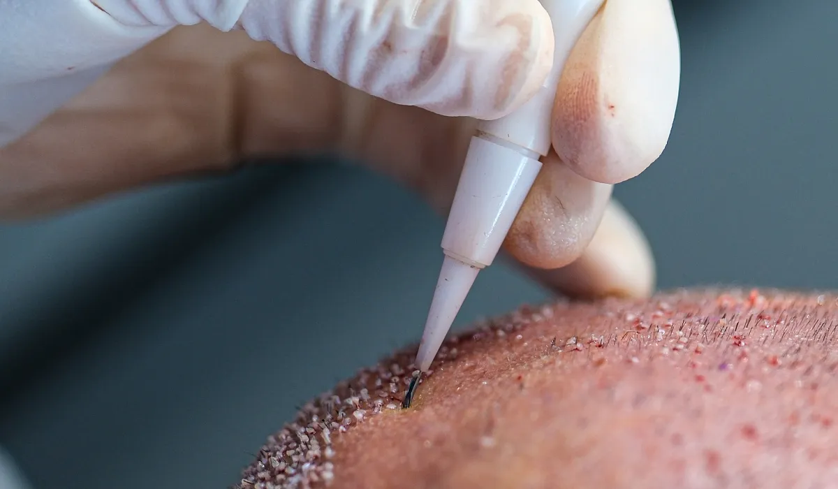 Diddy-Haartransplantatie-6 Diddy-Haartransplantatie-6