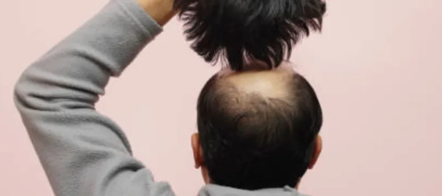 Do Wigs Cause Hair Loss