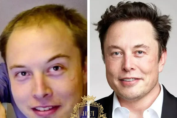 Elon Musks Haartransplantation: Was Wir Wissen Können Und Was Nicht