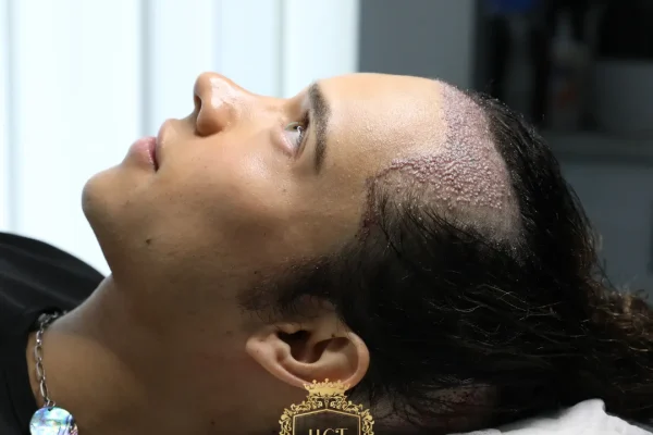 Wie man den besten Haartransplantationschirurgen in Amerika auswählt