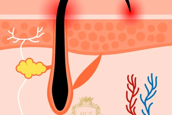 Pelos encravados: Guia completo de tratamento e prevenção