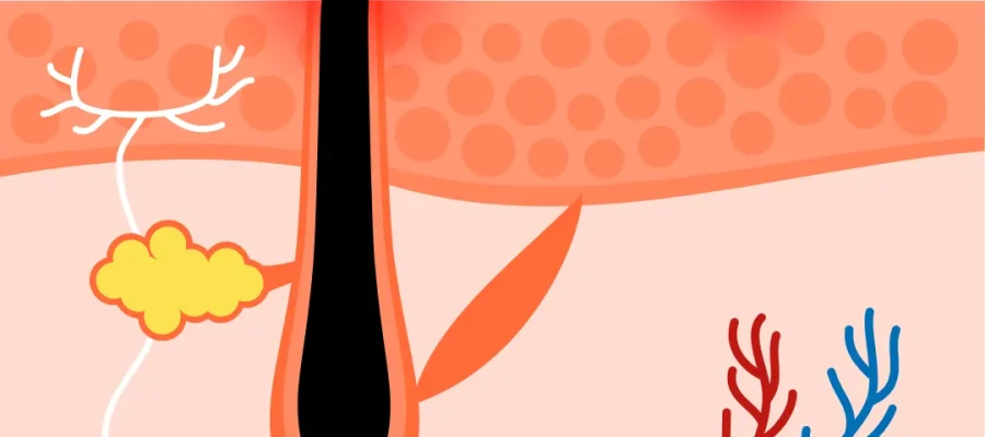 Complete gids voor de behandeling en preventie van ingegroeide haren F