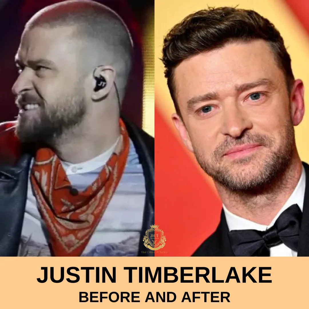 Justin Timberlake Hair Transplant |