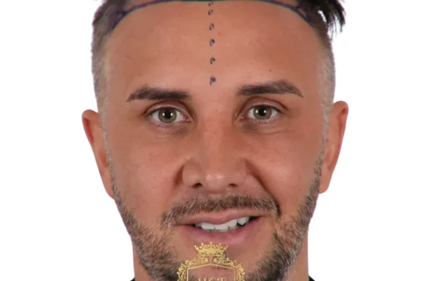 Keiran Lee Hair Transplant A Bold New Chapter in Confidence