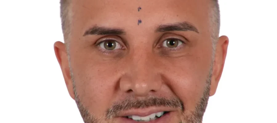 Keiran Lee Hair Transplant A Bold New Chapter in Confidence F