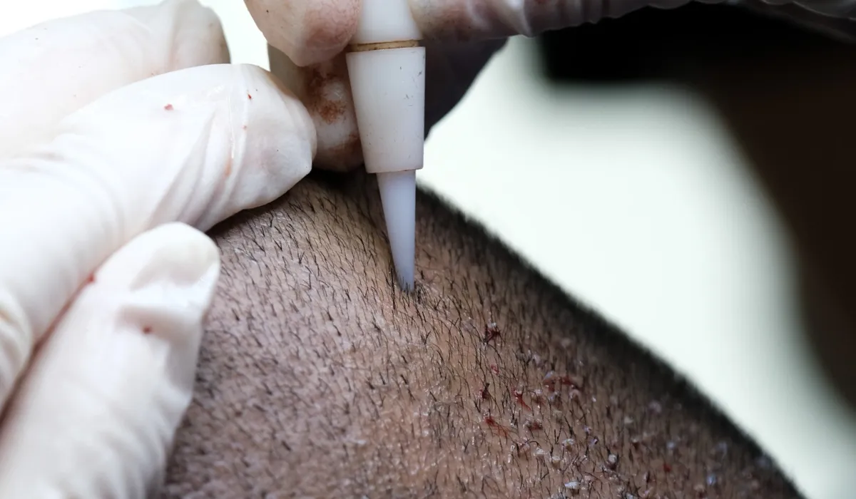 MGK-Haartransplantation-7 MGK-Haartransplantation-7