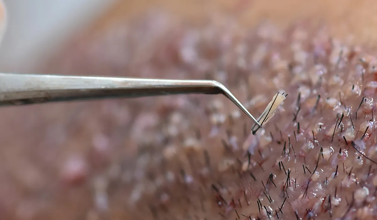 MGK-Haartransplantation-8 MGK-Haartransplantation-8