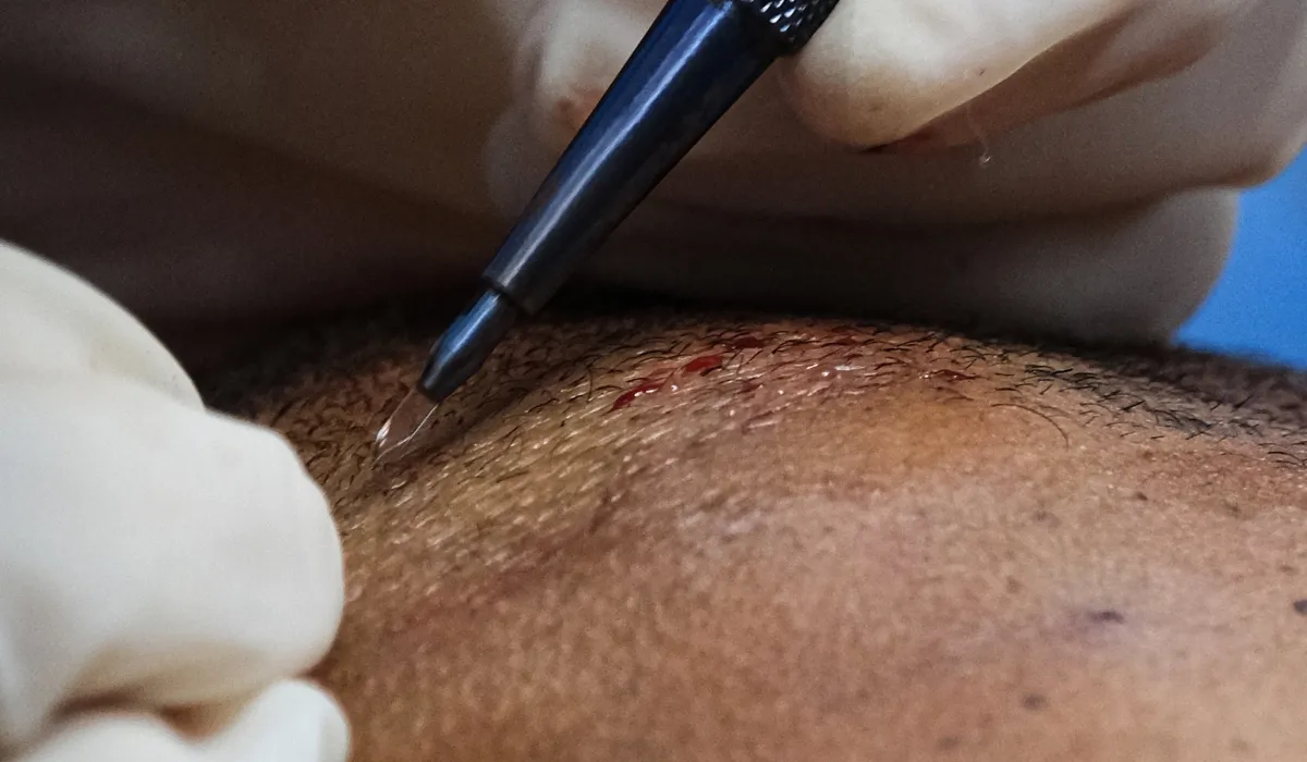 Mark-Wahlberg-Haartransplantatie-6 Mark-Wahlberg-Haartransplantatie-6