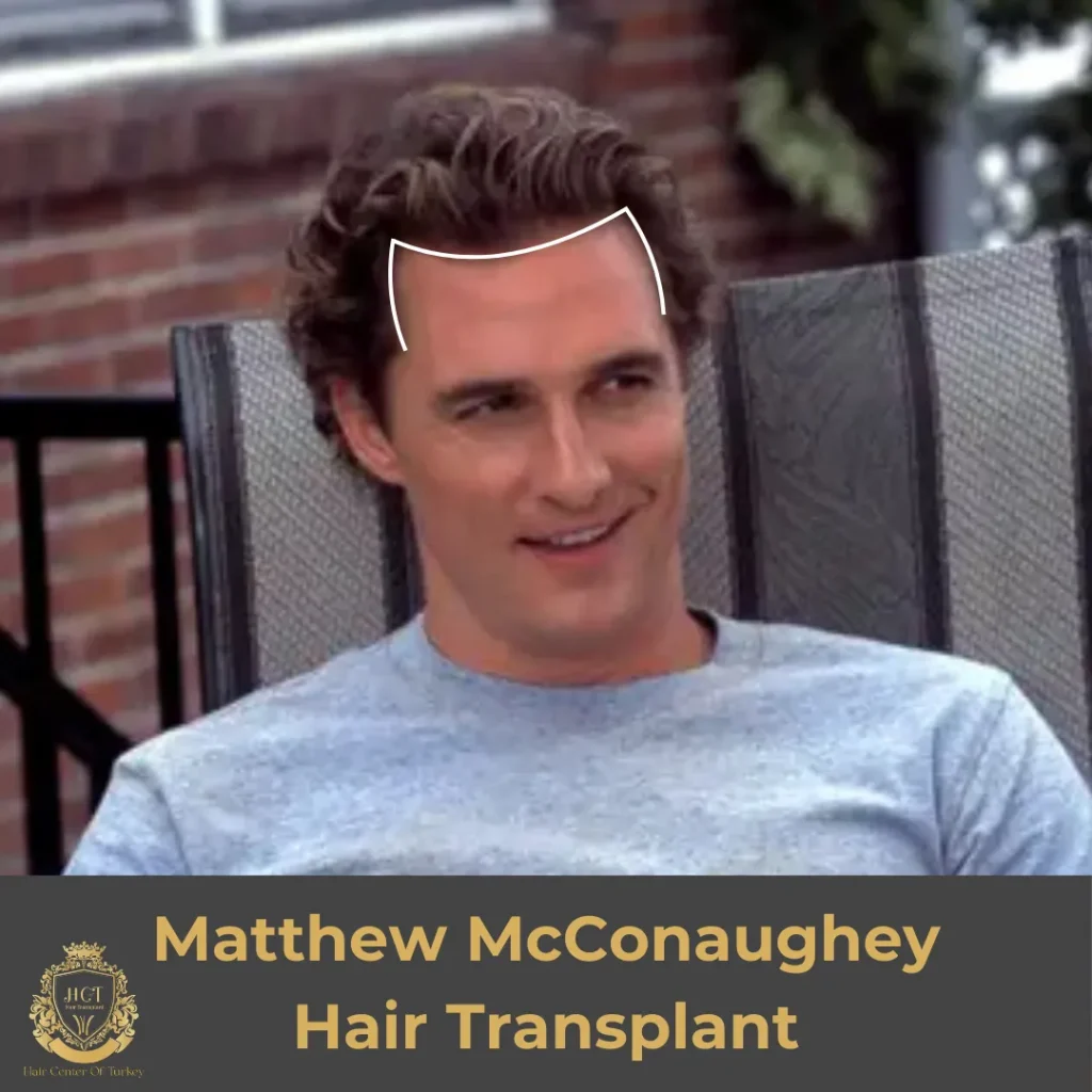 Trapianto di capelli di Matthew McConaughey