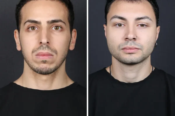 Linha do Cabelo Madura Versus Linha do Cabelo Recuada