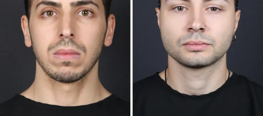 Mature Hairline Vs Receding Hairline