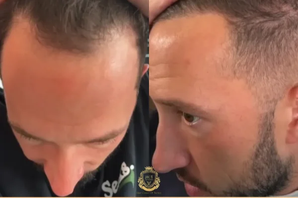 Mike Majlak (HeyBigMike) Haartransplantation