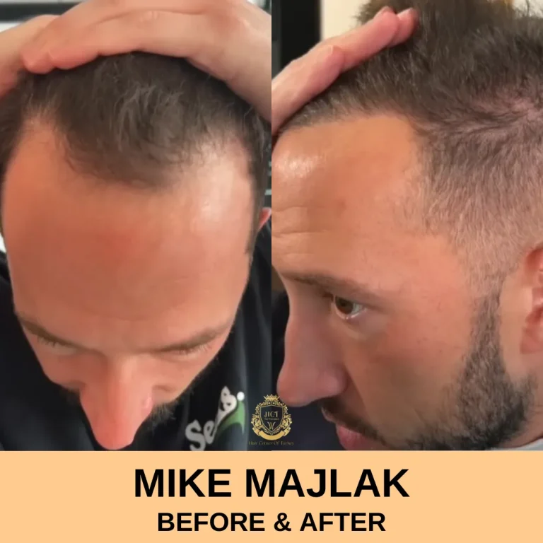 Trapianto di capelli Mike Majlak