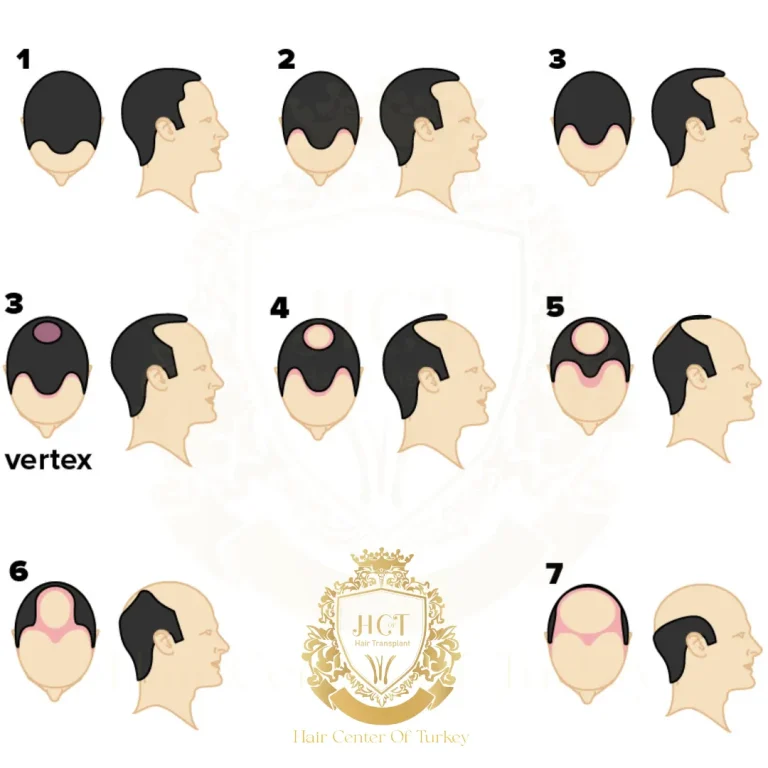 Norwood 1 Pérdida de cabello F