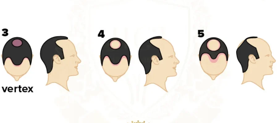 Norwood 1 Haaruitval