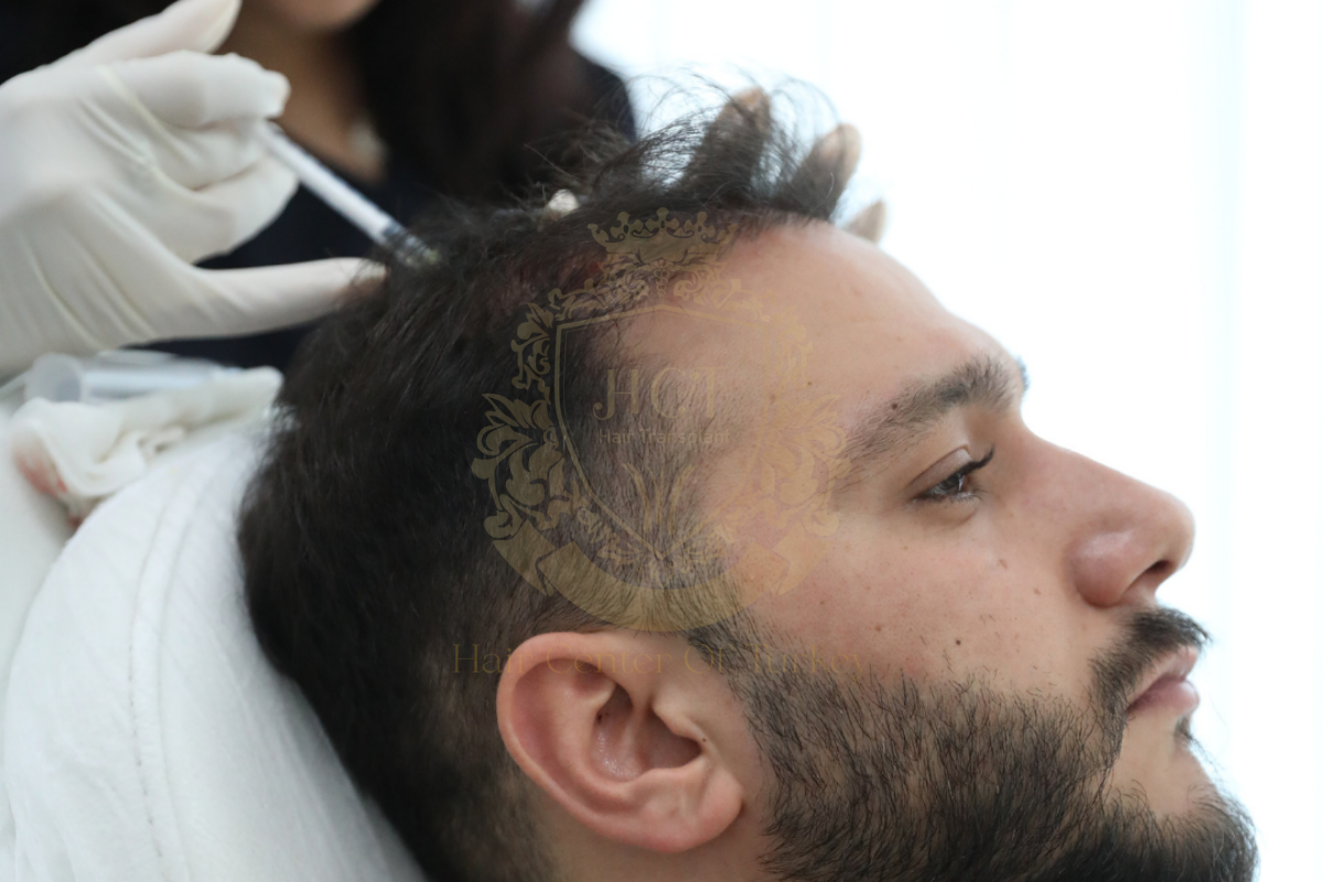 PRP therapy still popular receding hairline