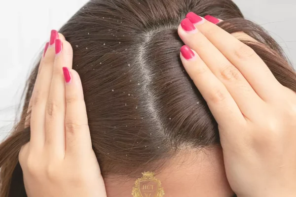 How to Get Rid of Dandruff?