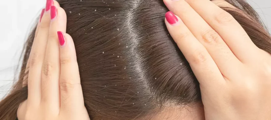 How to Get Rid of Dandruff?