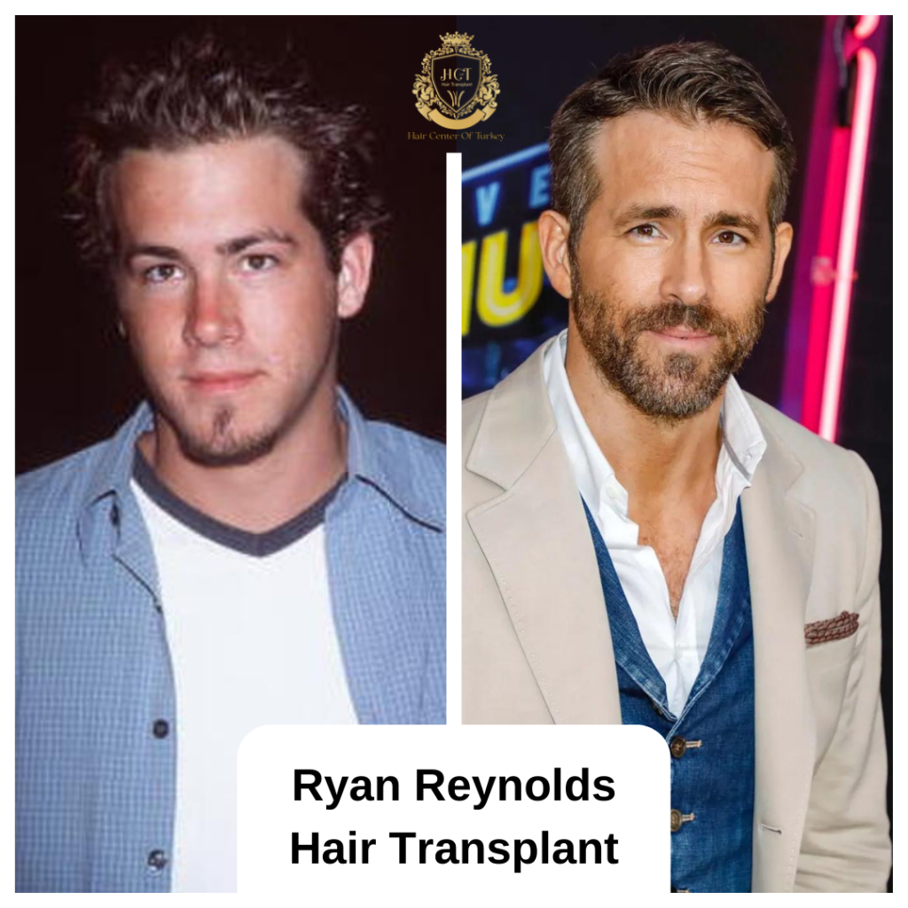 Ryan Reynolds Saç Ekimi Yaptırdı mı? Hair Center of Turkey Analizi