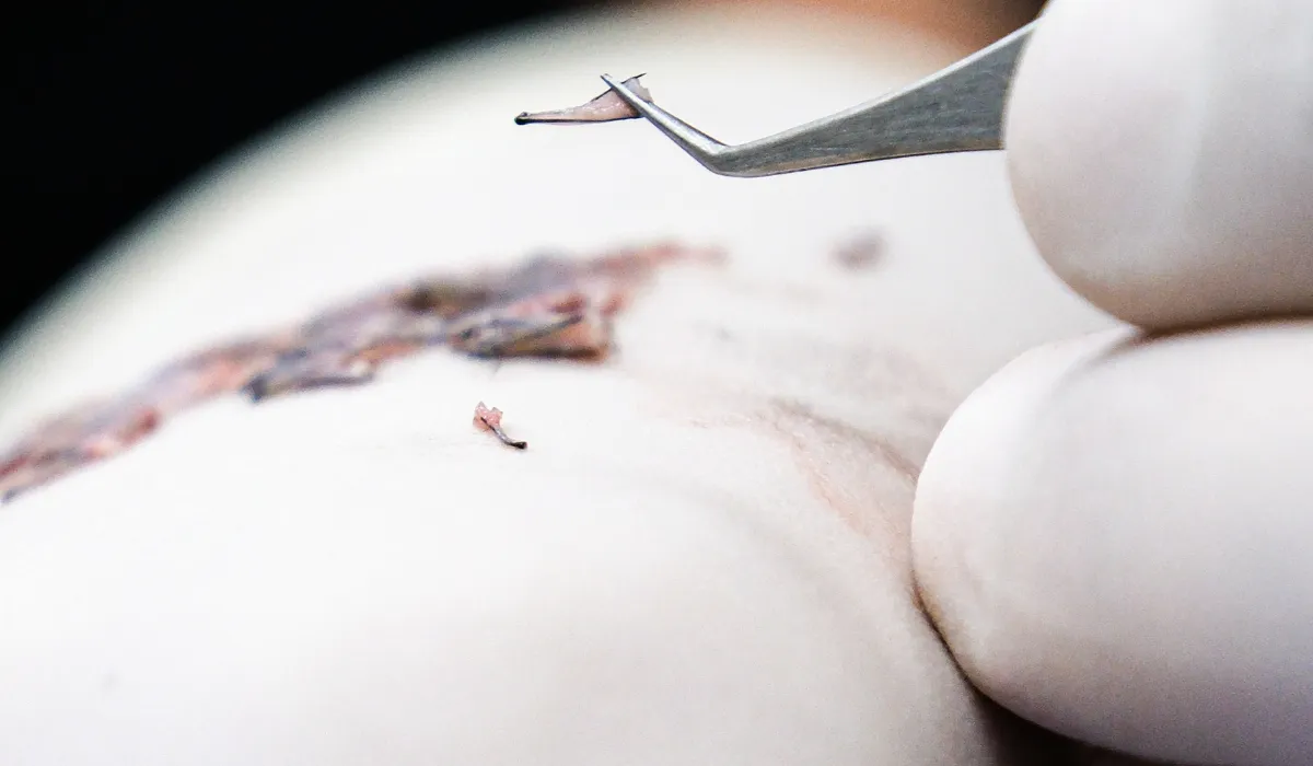 Seth Meyers Haartransplantatie-5 Seth Meyers Haartransplantatie-5