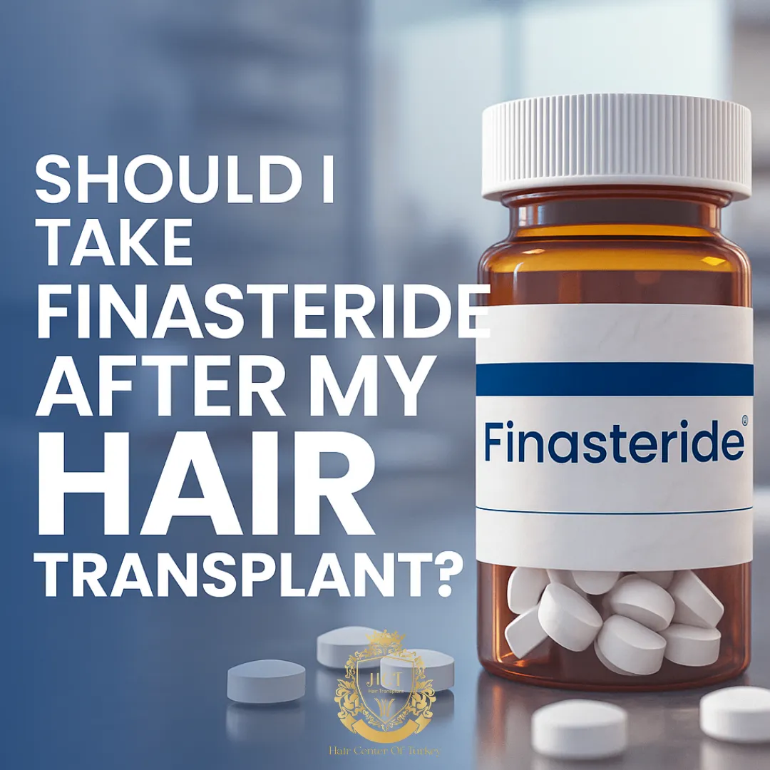 ¿Debería tomar finasterida después de mi trasplante capilar?