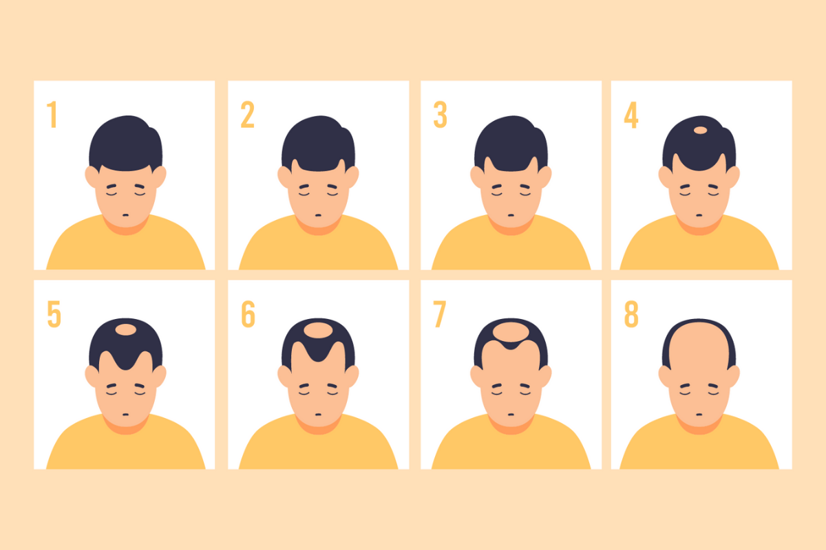 Kalıtsal Saç Dökülmesinin Belirtileri ve Aşamaları receding hairline