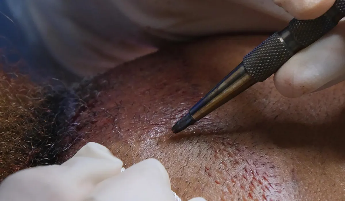 Theo-James-Haartransplantatie-6 Theo-James-Haartransplantatie-6