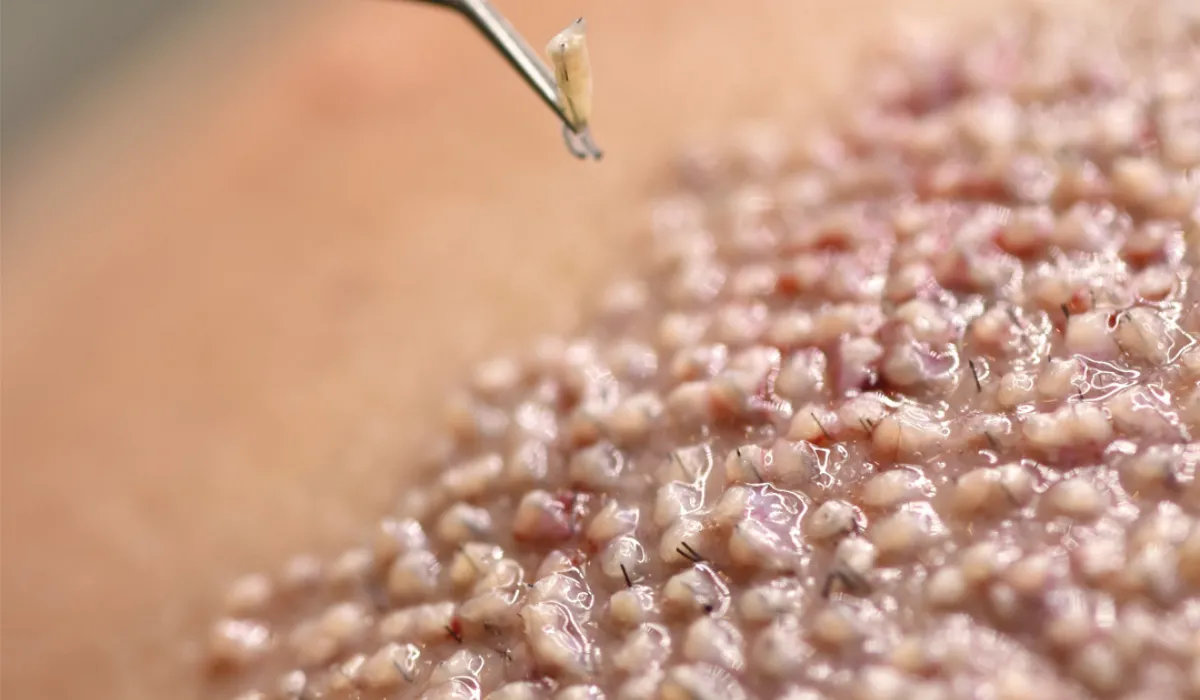 Tiger Woods haartransplantatie 7 Tiger Woods haartransplantatie 7