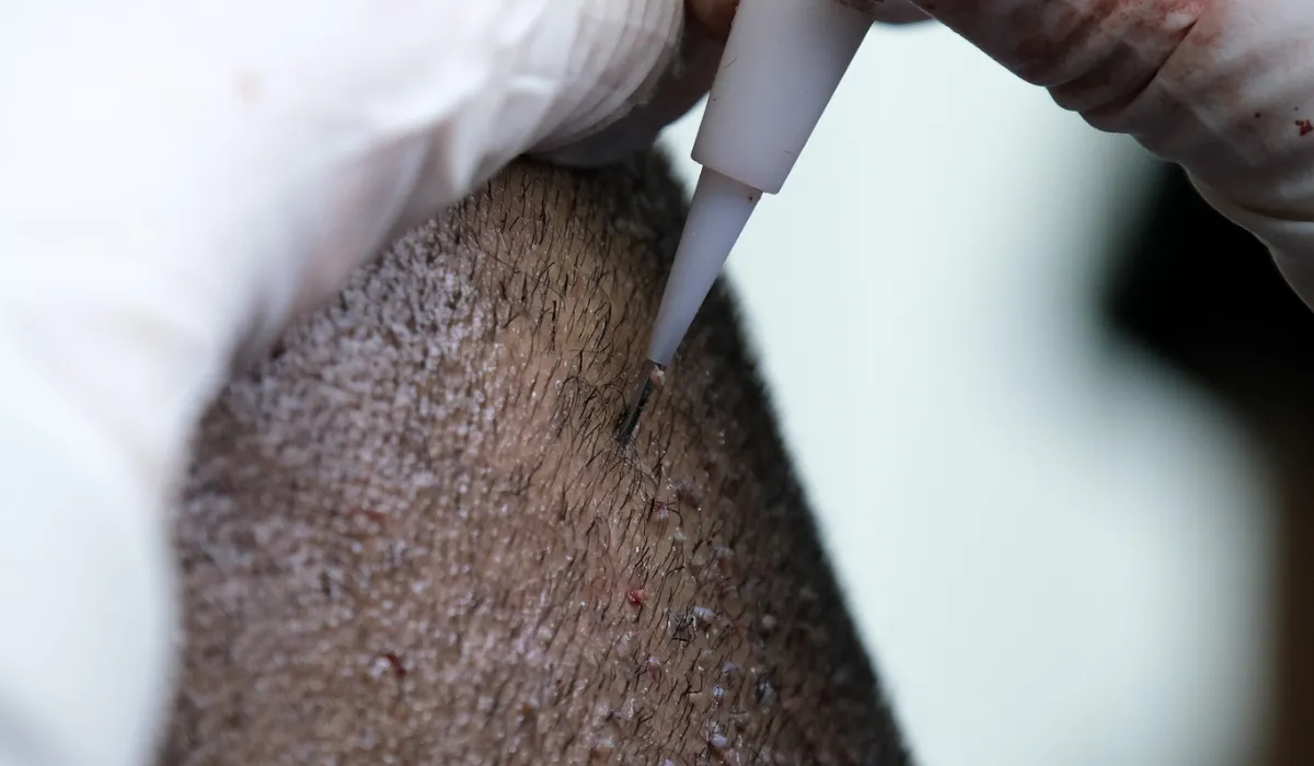 Timbaland-Haartransplantatie-7 Timbaland-Haartransplantatie-7