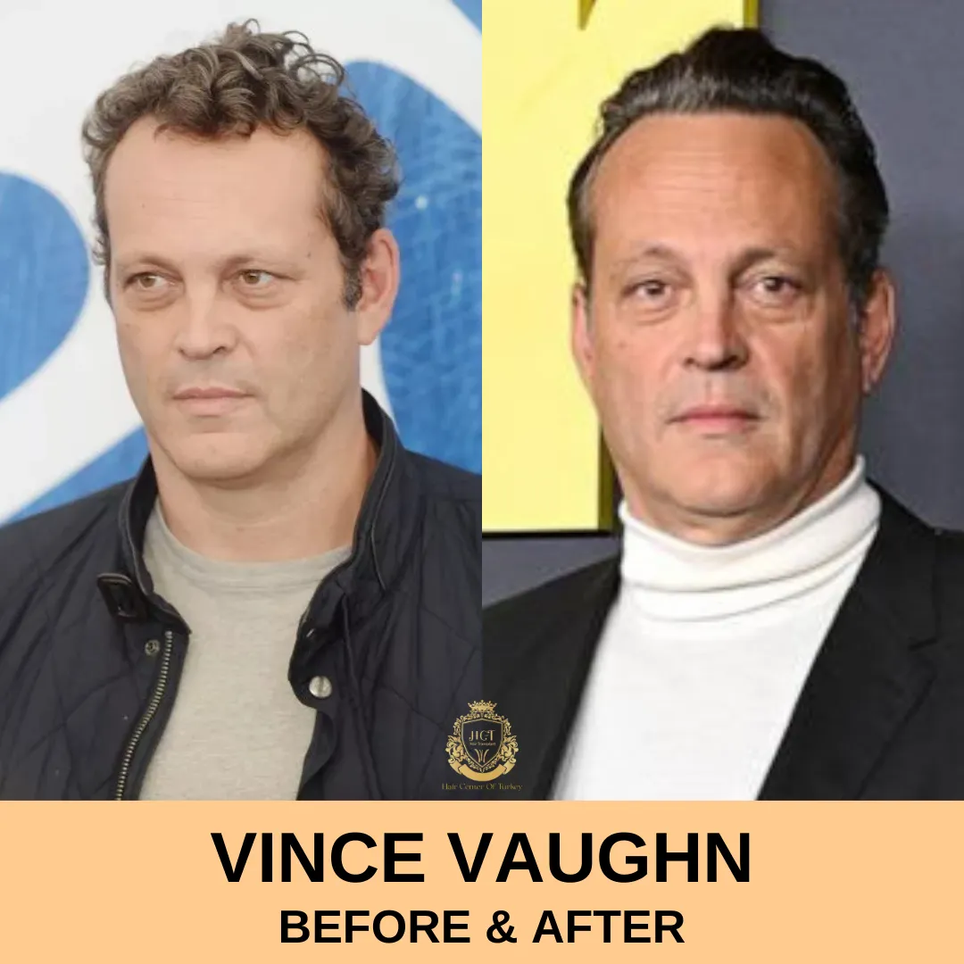 Vince Vaughn Trasplante de pelo 1 Vince Vaughn Hair Transplant