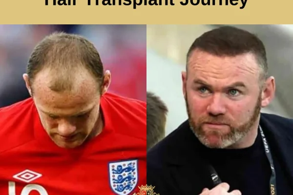 Wayne Rooney Haarverpflanzung: Was Geschah, Was Er Hatte Und Was Man Daraus Lernen Kann
