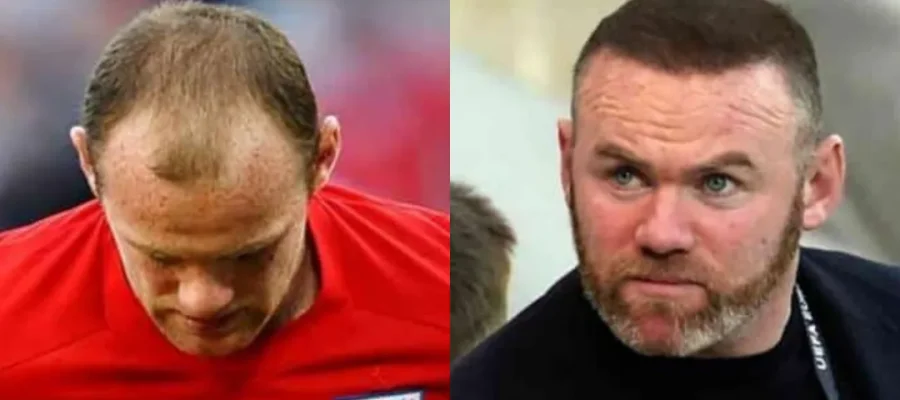 Wayne Rooney Haarverpflanzung: Was Geschah, Was Er Hatte Und Was Man Daraus Lernen Kann
