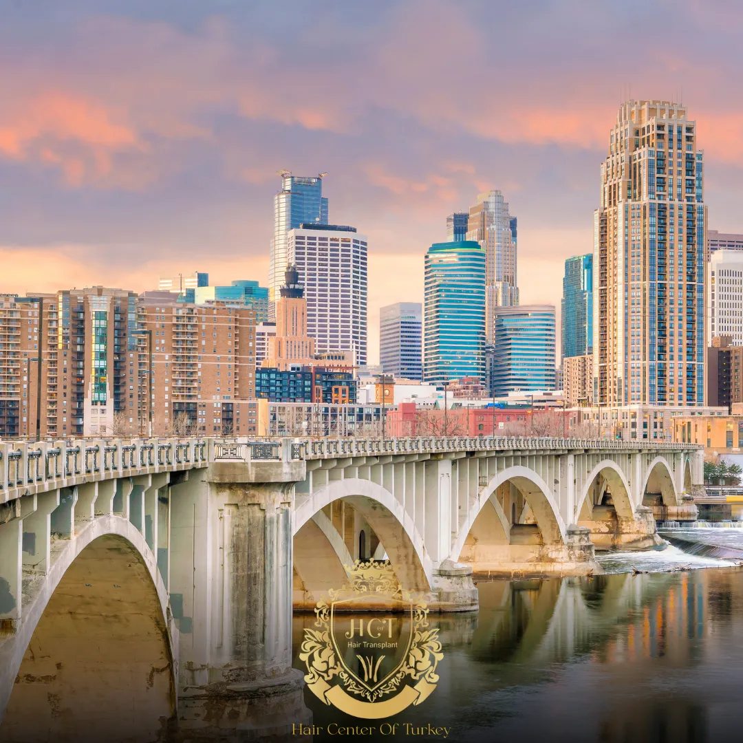 What Are the Best Hair Transplant Clinics in Minneapolis F