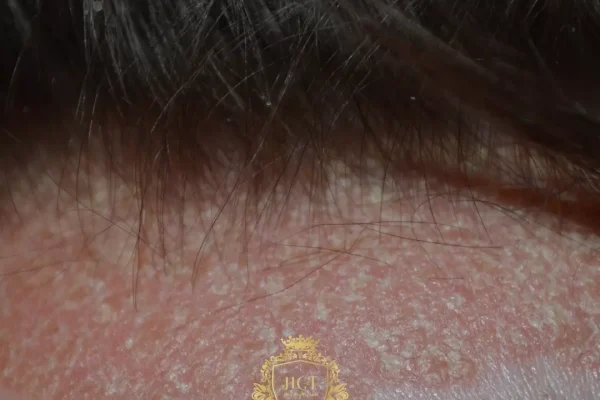 What Can Soothe Your Scalp: Tips for Tackling Scalp Eczema