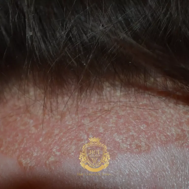 What Can Soothe Your Scalp: Tips for Tackling Scalp Eczema