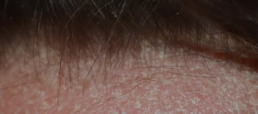 Wat kan je hoofdhuid kalmeren?