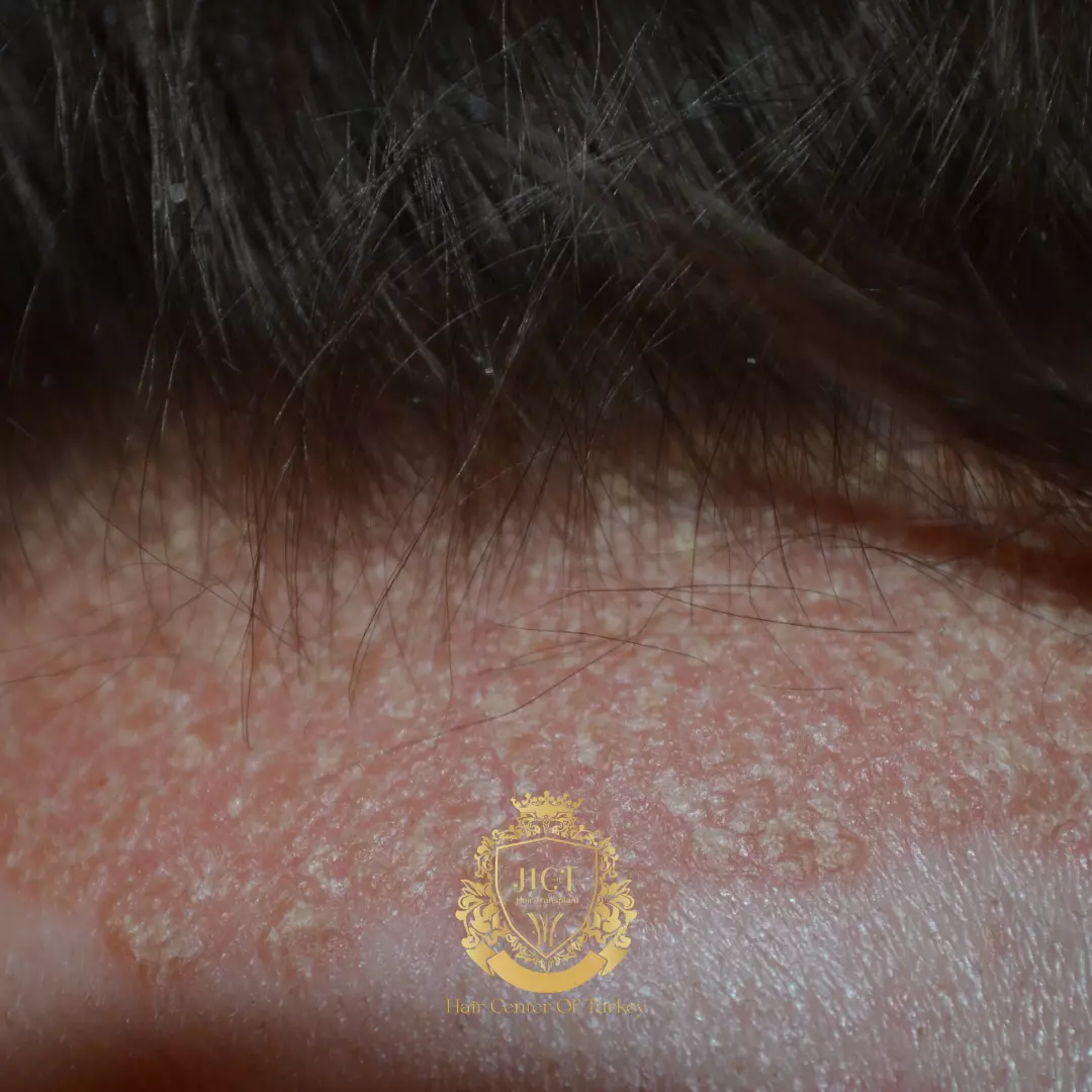 ¿Qué puede aliviar tu cuero cabelludo?