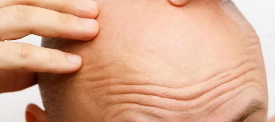 Wat is alopecia totalis en wat zijn de symptomen en oorzaken ervan?