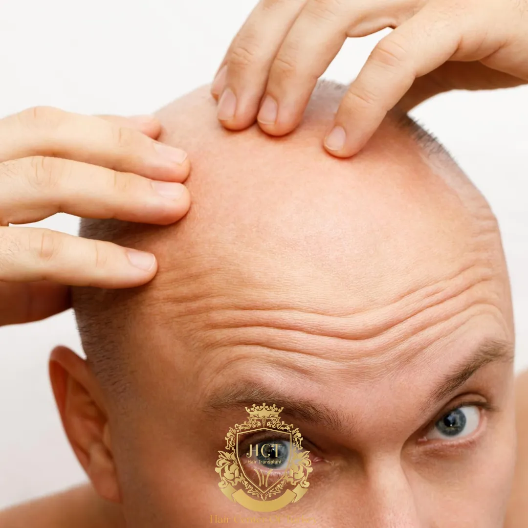 Wat is alopecia totalis en wat zijn de symptomen en oorzaken ervan?
