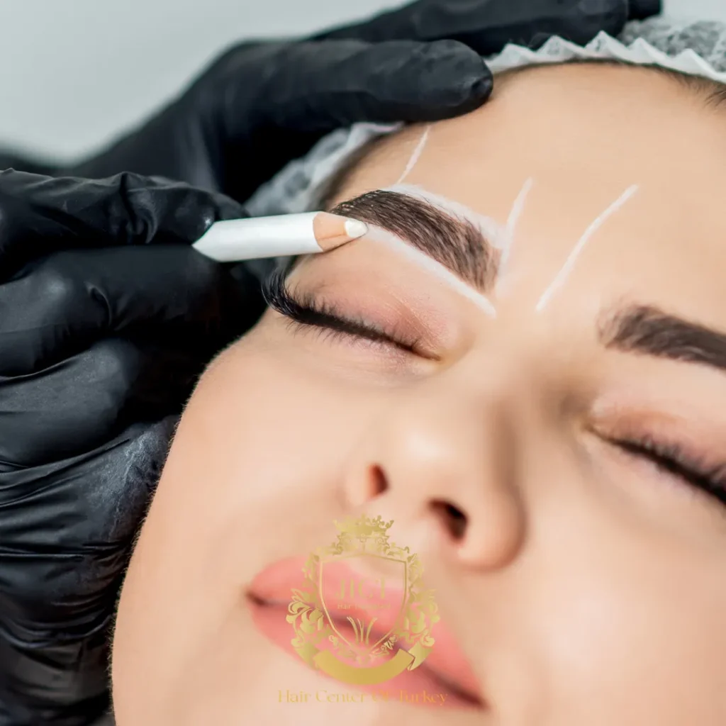 Qu'est-ce qu'une greffe de sourcils Micro FUE