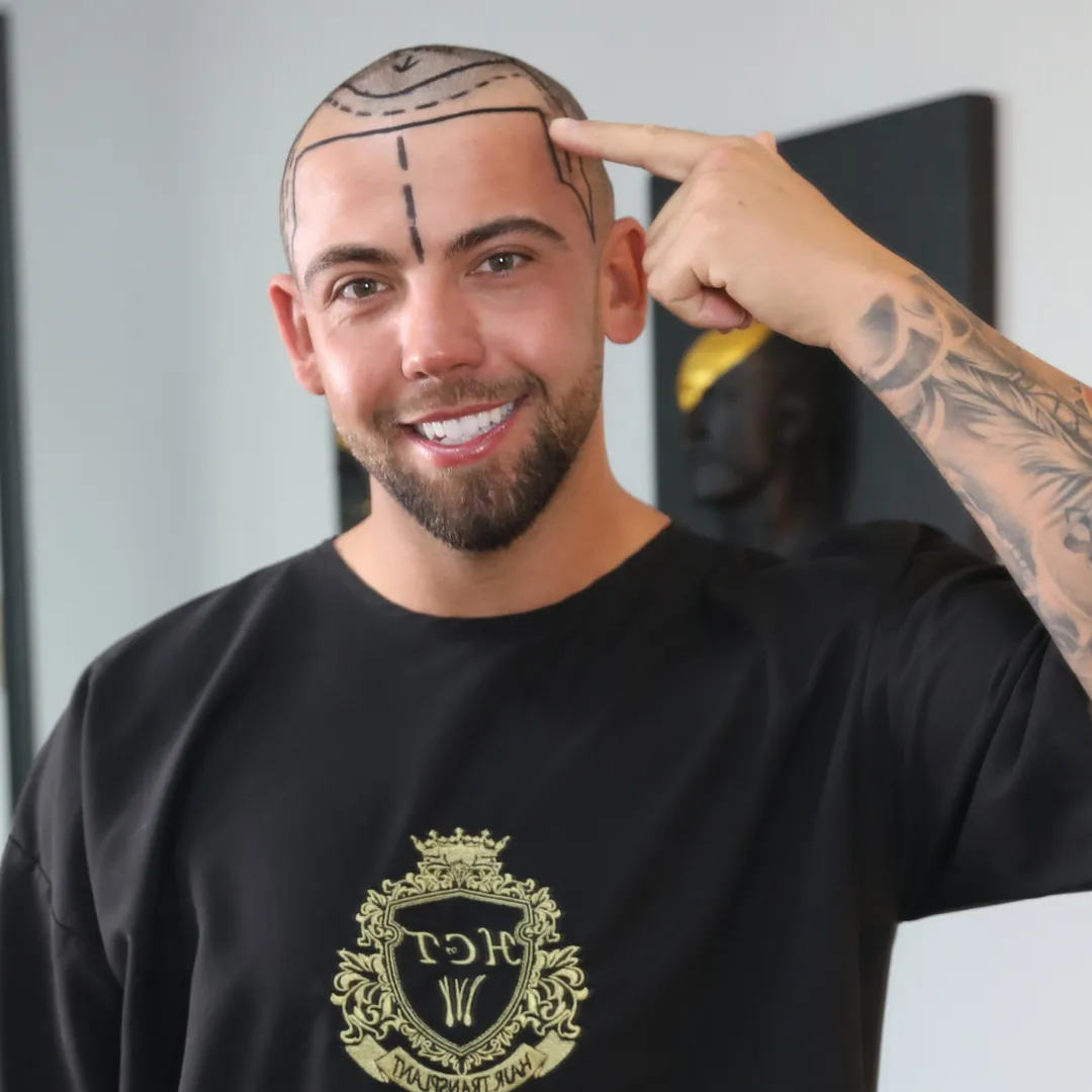 Beste leeftijd voor een haartransplantatie