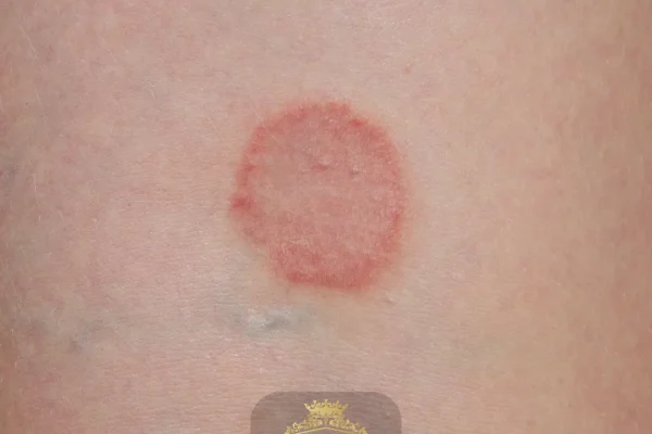 O que é a tinea capitis e como ela pode ser tratada?